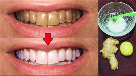 Natural Teeth Whitening: The Key to a Dazzling Smile